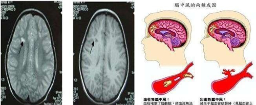 经颅磁刺激仪—什么原因会导致脑血栓