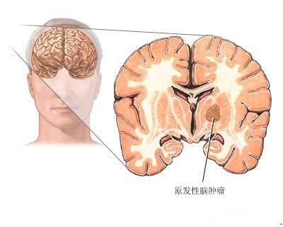 经颅磁刺激仪真的有效果吗|如何治疗早期癫痫病