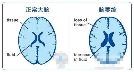 安全的物理疗法_照顾脑萎缩病人需要注意什么