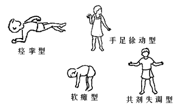 经颅磁治疗仪的作用_脑瘫这些误区怎样避免