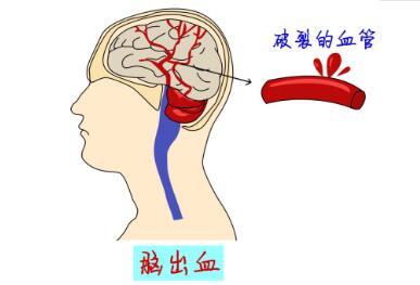 经颅磁刺激仪真的有效果吗_脑出血可以治好吗