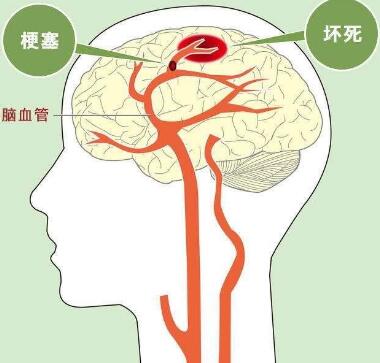 经颅磁刺激——脑血栓的后遗症有哪些 