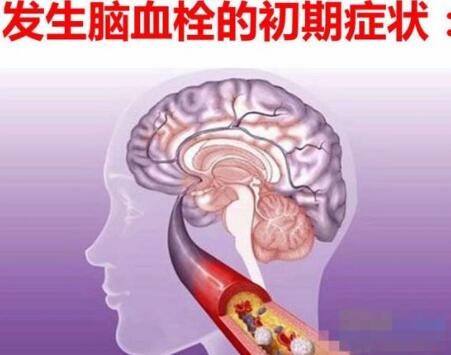 经颅磁刺激仪是真的吗?脑血栓的人吃什么好 