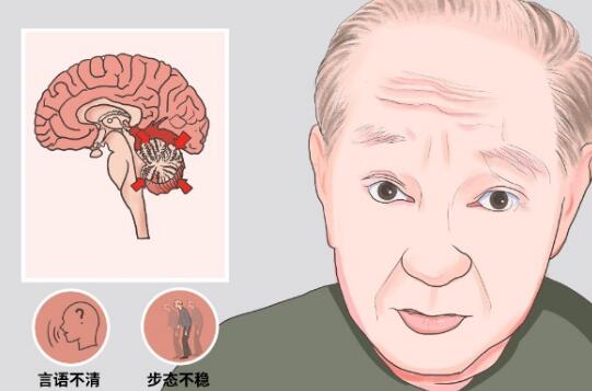 经颅磁刺激治疗仪——怎样缓解脑萎缩的方法 